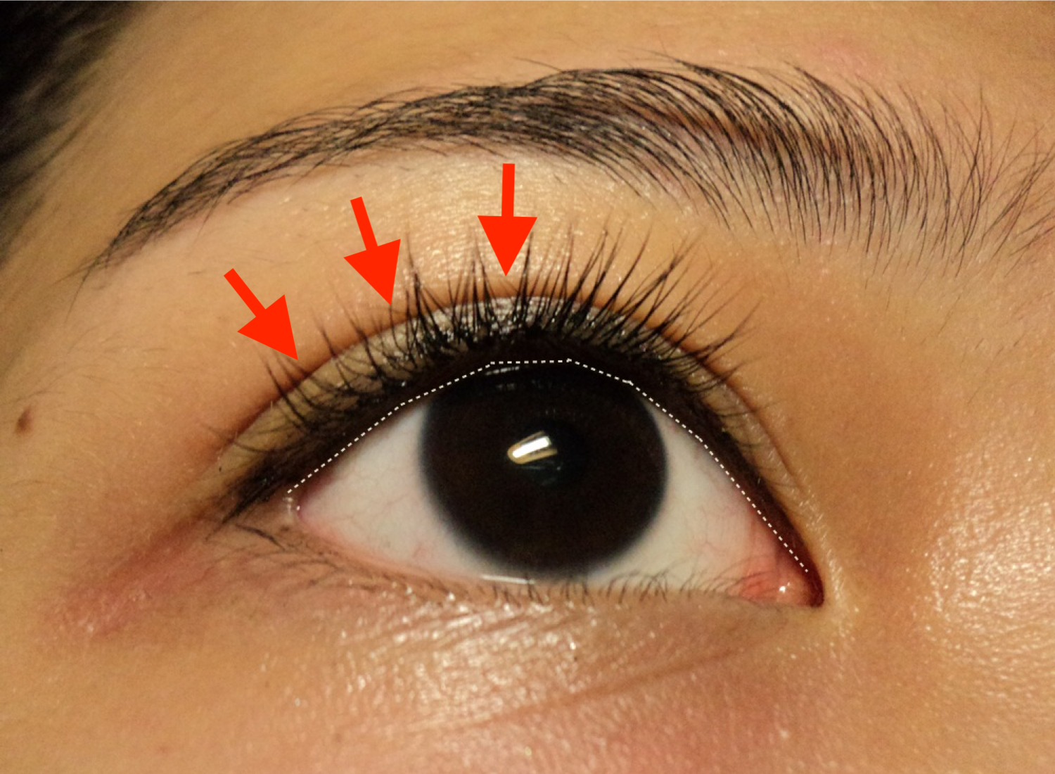 Eyelid Bags and Skin folds